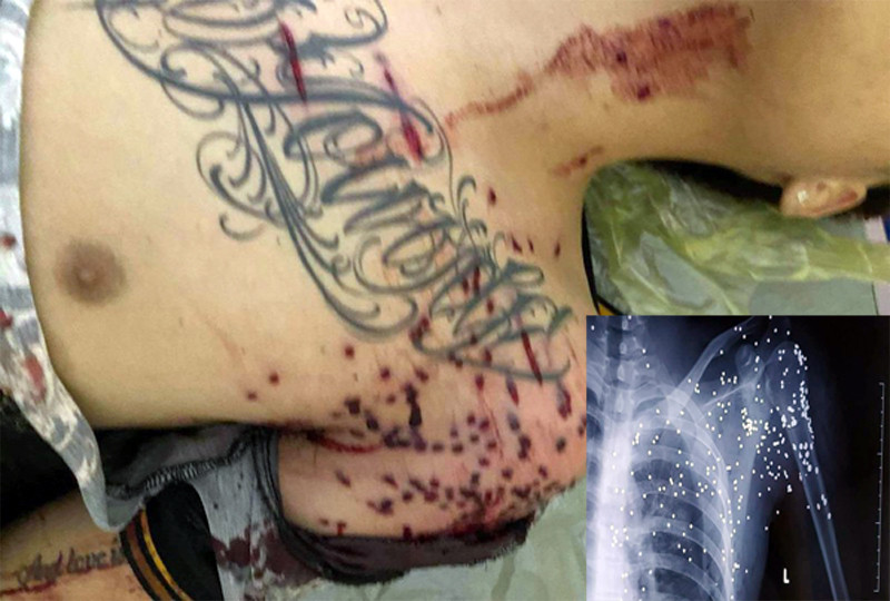 Nạn nhân trong vụ nổ súng với chi chít vết đạn trên cơ thể Nạn nhân trong vụ nổ súng với chi chít vết đạn trên cơ thể