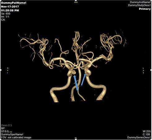 Hình ảnh chuỗi xung mạch não (MRA tof 3D) của một bệnh nhân nữ 54 tuổi sàng lọc mạch não phát hiện túi phình động mạch (vị trí mũi tên) và đã được can thiệp nút túi phình động mạch não phải tại Vinmec