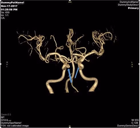 Hình ảnh chuỗi xung mạch não (MRA tof 3D) của một bệnh nhân nữ 54 tuổi sàng lọc mạch não phát hiện túi phình động mạch (vị trí mũi tên) và đã được can thiệp nút túi phình động mạch não phải tại Vinmec