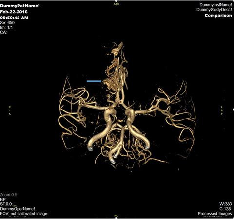 Hình ảnh dị dạng thông động tĩnh mạch vùng trán phải của một bệnh nhân nam 40 tuổi. Bệnh nhân đã được can thiệp nút khối dị dạng tại Vinmec và hồi phục sức khỏe tốt