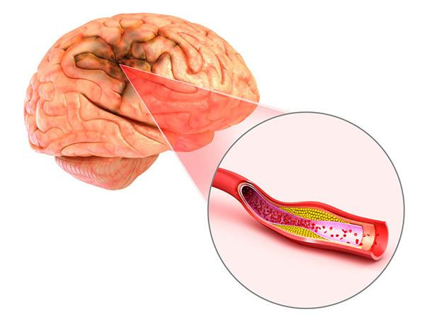 Hình ảnh đột quỵ nhồi máu não do xơ vữa mạch máu