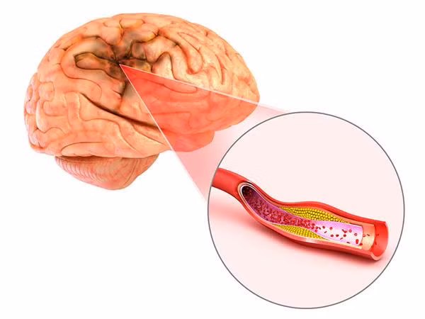 Hình ảnh đột quỵ nhồi máu não do xơ vữa mạch máu