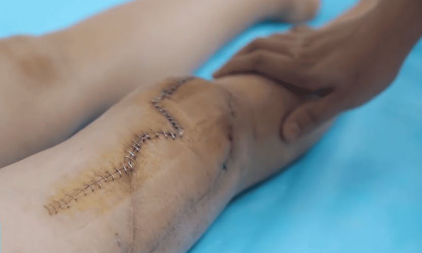 Đôi chân chằng chịt sẹo sau nhiều lẫn phẫu thuật tại các cơ sở y tế khác vẫn không thể giúp bệnh nhân đi lại Đôi chân chằng chịt sẹo sau nhiều lẫn phẫu thuật tại các cơ sở y tế khác vẫn không thể giúp bệnh nhân đi lại