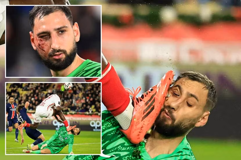 Khuôn mặt biến dạng của Donnarumma sau chấn thương