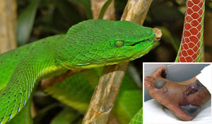 Khi bị rắn cắn, việc lấy mật rắn đắp vào vết thương chẳng những không có tác dụng mà còn dễ gây nhiễm trùng tại chỗ (ảnh minh họa)