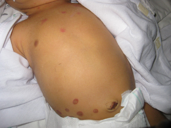 Trẻ rất dễ bị uốn ván vì nhiễm trùng do sử dụng các dụng cụ chưa được sát trùng (ảnh BV Nhi Đồng 2)