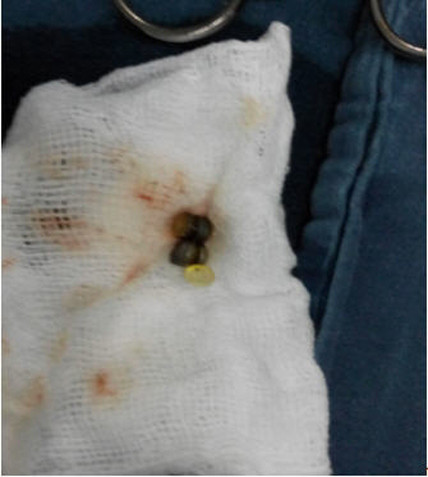 Báo động tình trạng hóc dị vật ở trẻ em ảnh 2