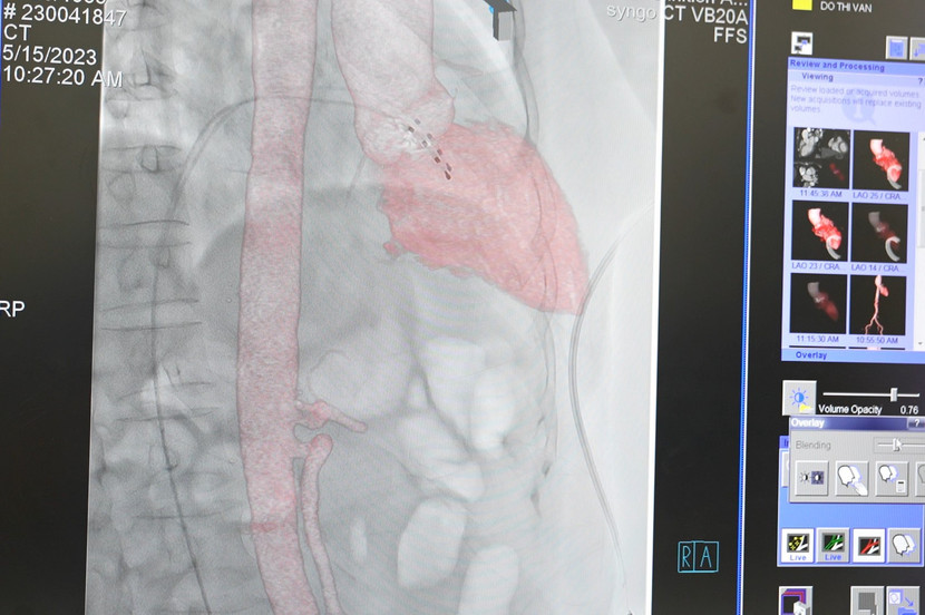Hệ thống chụp mạch máu xóa nền giúp các bác sĩ thực hiện can thiệp chuẩn xác Hệ thống chụp mạch máu xóa nền giúp các bác sĩ thực hiện can thiệp chuẩn xác