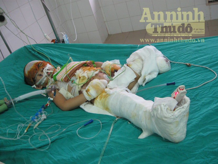Vụ nổ xe máy kinh hoàng: Bé Vân được đưa về quê vì quá nguy kịch ảnh 1