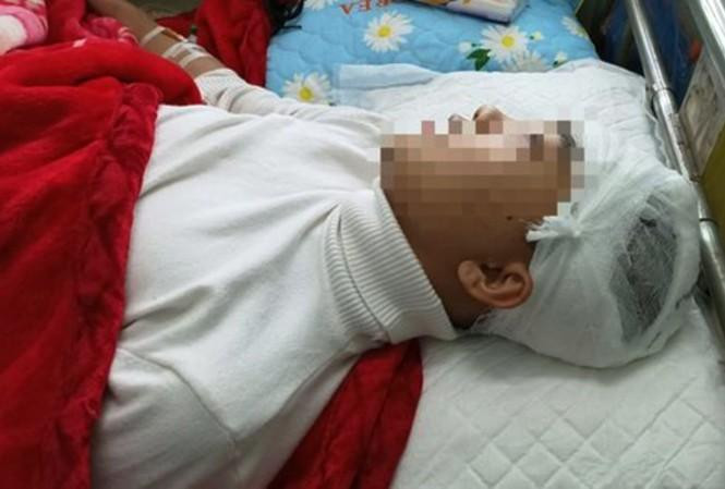 Nạn nhân bị bạn học cùng trường đánh vỡ sọ não
