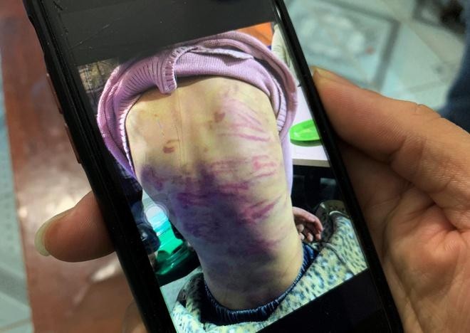 Người thân cung cấp hình ảnh chụp vết thương trên cơ thể bé gái Người thân cung cấp hình ảnh chụp vết thương trên cơ thể bé gái