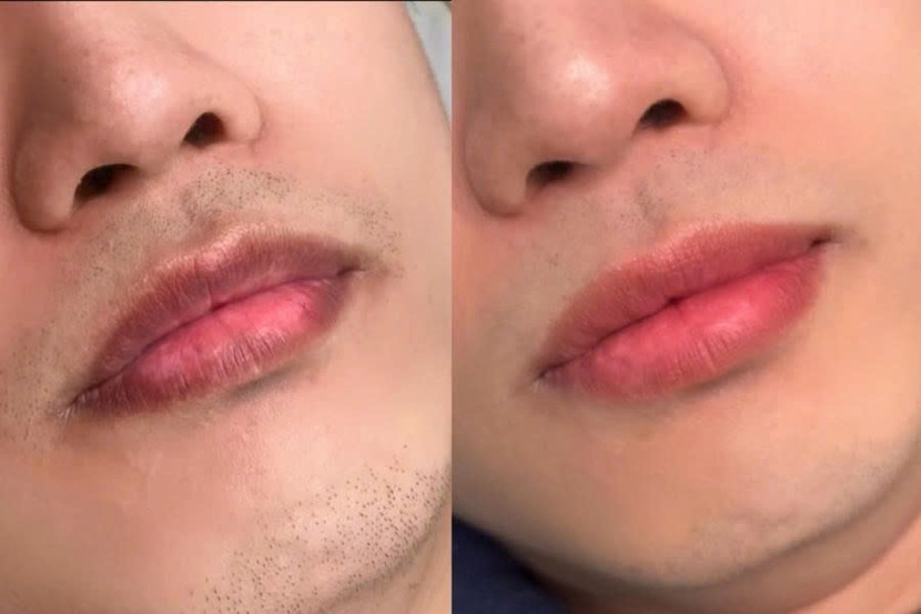 Hình ảnh trước và sau khi nam giới phun môi dành cho nam Hình ảnh trước và sau khi nam giới phun môi dành cho nam