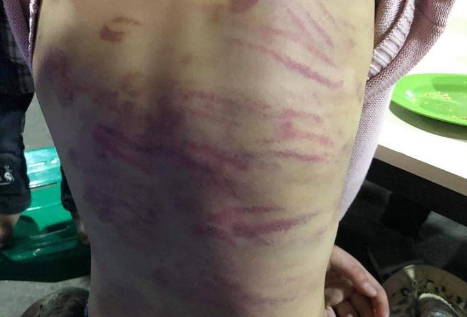 Bé gái 12 tuổi bị đánh đập, hiếp dâm, trên người đầy vết bầm tím