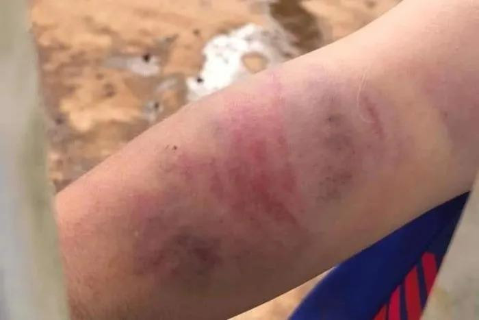 Vết thương tích trên người bé trai 9 tuổi Vết thương tích trên người bé trai 9 tuổi