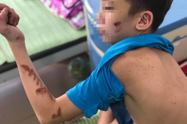 Cậu bé 14 tuổi bị chủ quán bánh xèo bạo hành với chi chít vết thương trên người Cậu bé 14 tuổi bị chủ quán bánh xèo bạo hành với chi chít vết thương trên người