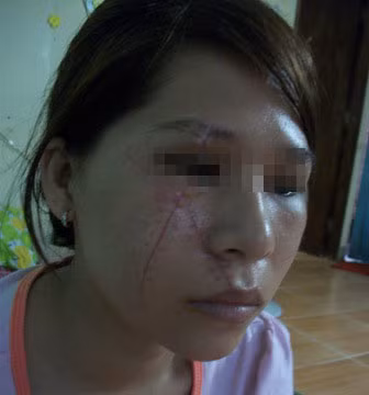 Nạn nhân sau 15 ngày điều trị