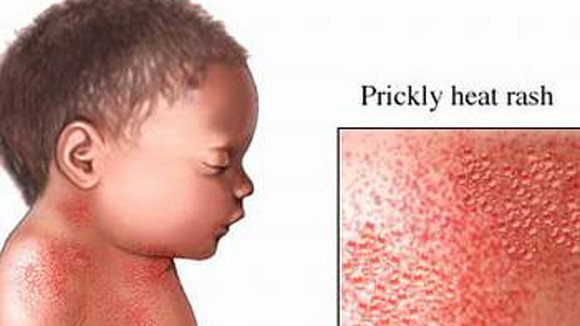 Trị rôm sảy ở trẻ nhỏ ảnh 1