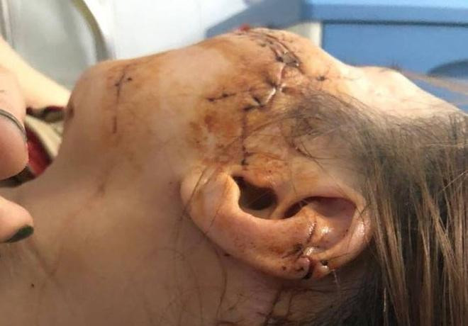 Hình ảnh khuôn mặt người phụ nữ bị chồng đâm, rạch nhiều nhát lên mặt Hình ảnh khuôn mặt người phụ nữ bị chồng đâm, rạch nhiều nhát lên mặt