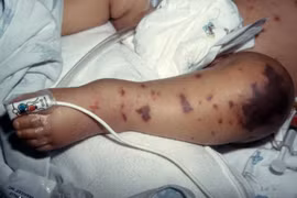 Bốn ca tử vong do não mô cầu, Bộ Y tế cảnh báo nguy cơ