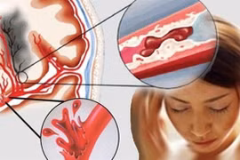 Thói quen phổ biến vào mùa lạnh làm tăng nguy cơ đột tử 