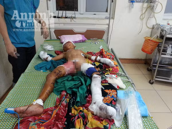 Đồ chơi lạ phát nổ, bé trai 9 tuổi bị đa chấn thương ảnh 1