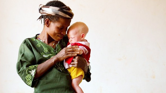 Người bạch tạng sống trong hãi hùng ảnh 1