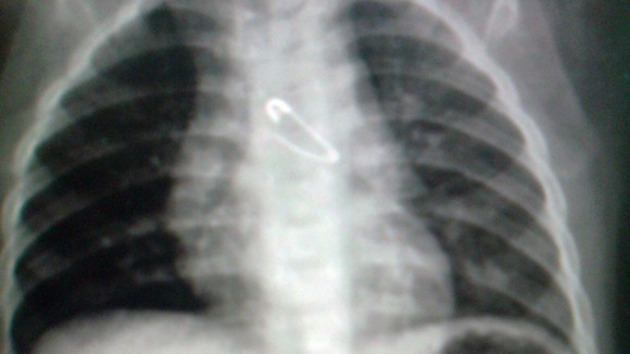 Trẻ 10 tháng tuổi nuốt kim băng vào bụng ảnh 1