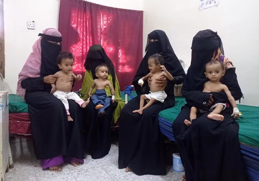 Trẻ em suy dinh dưỡng được điều trị tại bệnh viện ở Hodeida, Yemen