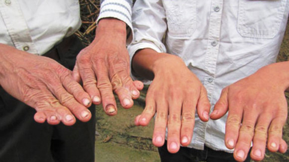 Giải mã những bàn tay 6 ngón ảnh 1