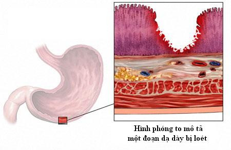 Viêm loét dạ dày ngày càng lan rộng ảnh 1
