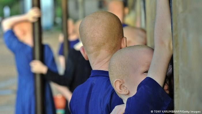 Khắp châu Phi, người mắc chứng bệnh bạch tạng có thể đối mặt với rủi ro, thậm chí cho chính tính mạng của họ Khắp châu Phi, người mắc chứng bệnh bạch tạng có thể đối mặt với rủi ro, thậm chí cho chính tính mạng của họ