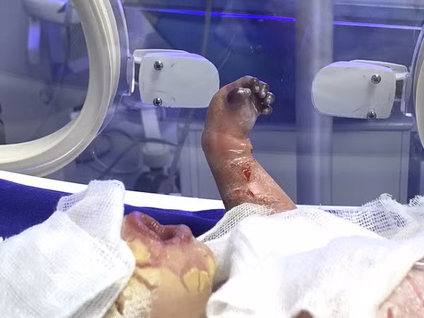 Cháu bé sơ sinh mắc bệnh da vảy cá được chăm sóc trong lồng ấp