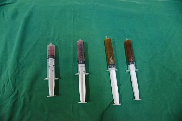 Bơm cồn tuyệt đối để điều trị nang giáp là phương pháp rất mới