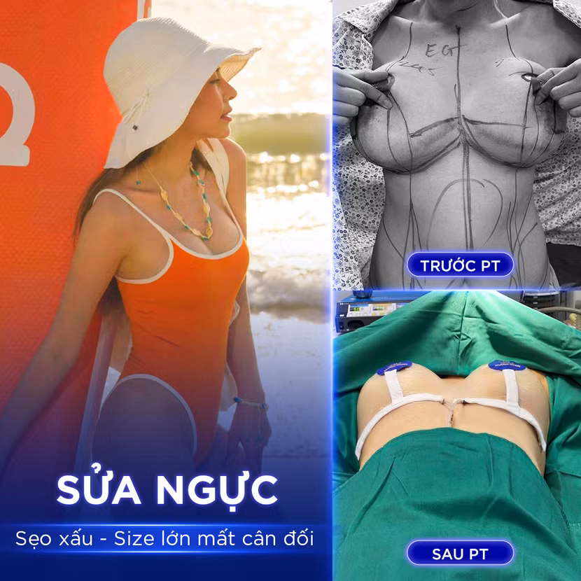 Kết quả sửa ngực sẹo xấu - size lớn mất cân đối của chị Đường Thu Cúc