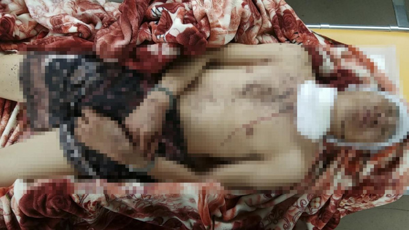 Đối tượng Cà Văn Biển đang được điều trị tại Bệnh viện đa khoa huyện Thuận Cha