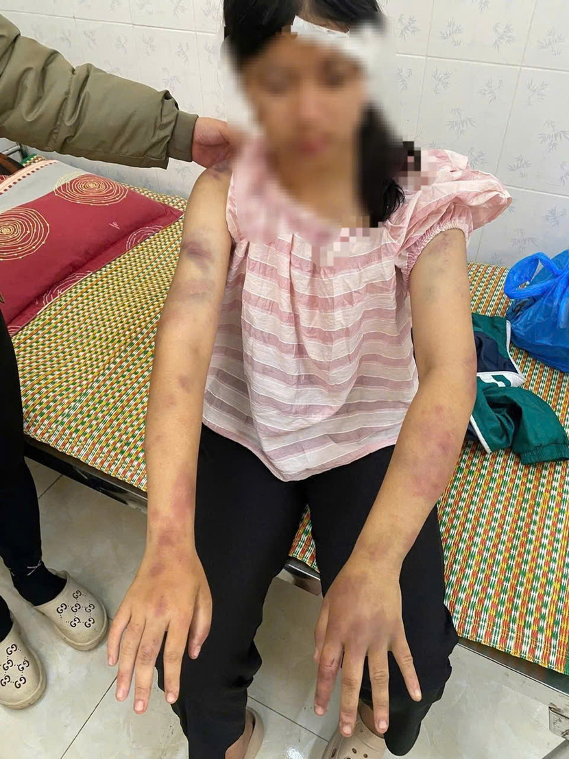 Cháu P.A với những vết bầm tím chằng chịt trên cơ thể