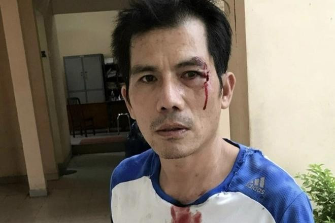 Ông Đào Minh Quân bị hàng xóm dùng đá ném vào mặt khi chỉ ranh giới đất để đo vẽ. Ảnh: Zing