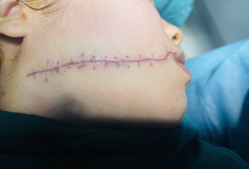 Vết sẹo sau khi được khâu lại. Ảnh: VOV