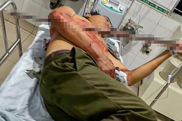 Nạn nhân được đưa đi cấp cứu với con dao phóng găm ở cánh tay. Nguồn: Zing