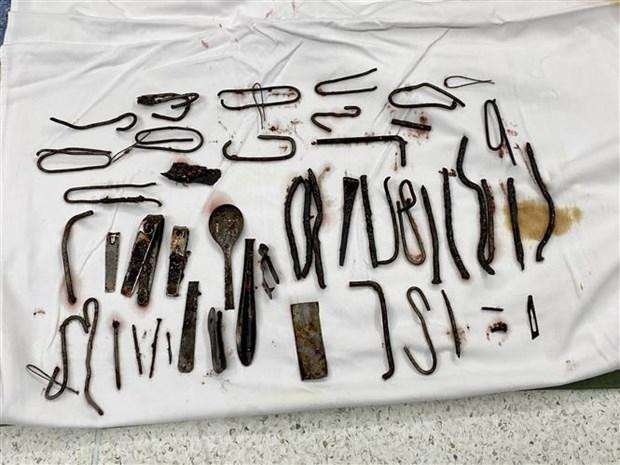 Hàng chục mảnh kim loại được lấy ra từ dạ dày của bệnh nhân. Ảnh: TTXVN Hàng chục mảnh kim loại được lấy ra từ dạ dày của bệnh nhân. Ảnh: TTXVN
