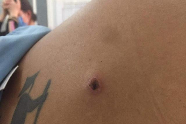 Anh Đăng bị thương ở dưới bả vai, kích thước vết thương 0,5 cm. Ảnh: Dân Trí