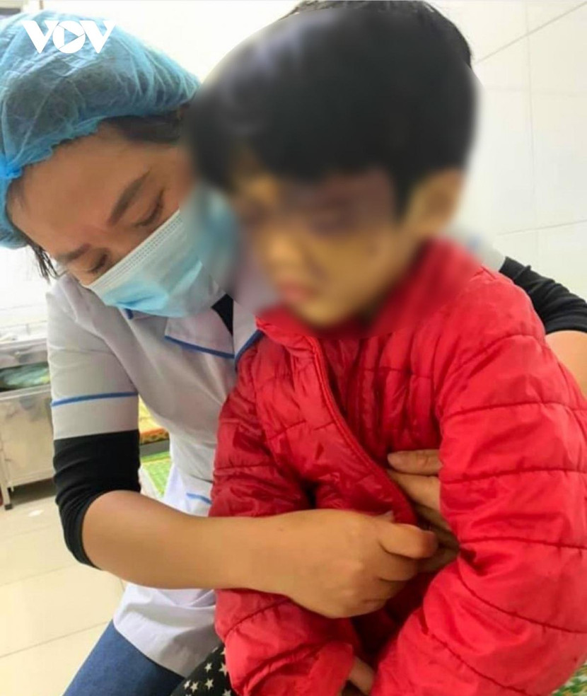 Cháu C. bầm tím vùng mắt do bị chính mẹ đẻ đánh. Ảnh: VOV Cháu C. bầm tím vùng mắt do bị chính mẹ đẻ đánh. Ảnh: VOV