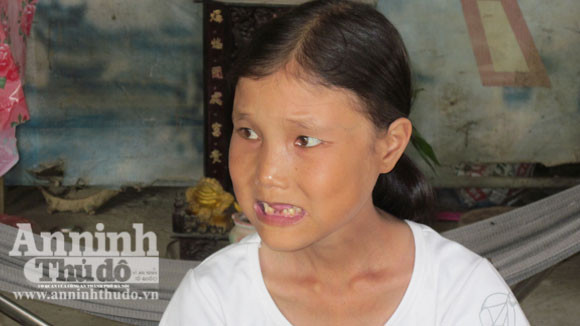 Mới 25 tuổi nhưng Như Ý đã rụng khoảng 10 chiếc răng, rất hom hem