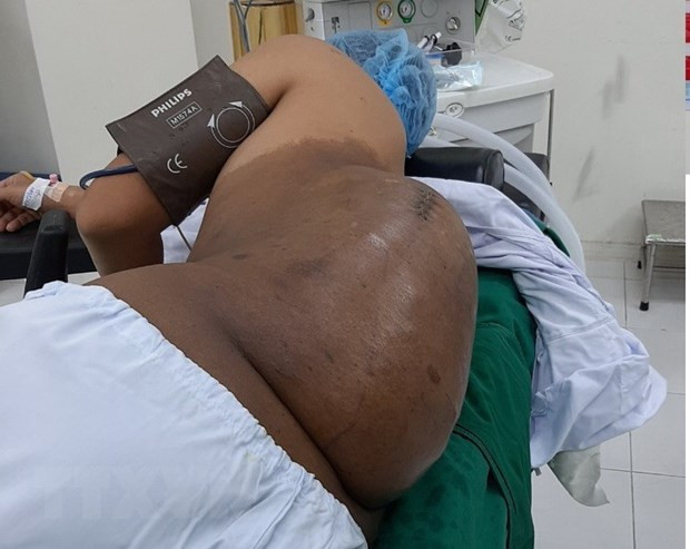 Hình ảnh khối u trước phẫu thuật. (Ảnh: TTXVN)