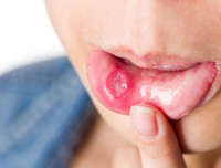 [ẢNH] Những giải pháp tự nhiên giúp điều trị nhiệt miệng cực hiệu quả