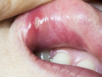 [ẢNH] Những giải pháp tự nhiên giúp điều trị nhiệt miệng cực hiệu quả