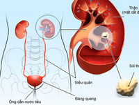 [ẢNH] Những dấu hiệu cảnh báo sớm bệnh sỏi thận bạn nên biết