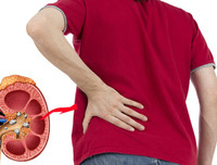 [ẢNH] Những dấu hiệu cảnh báo sớm bệnh sỏi thận bạn nên biết