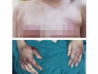 Hoại tử kinh hoàng trên cơ thể vì tiêm mỡ tự thân, chất làm đầy