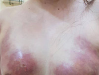 Hoại tử kinh hoàng trên cơ thể vì tiêm mỡ tự thân, chất làm đầy